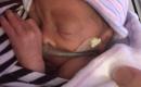 Premature baby.