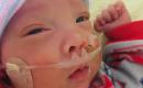 Premature baby.