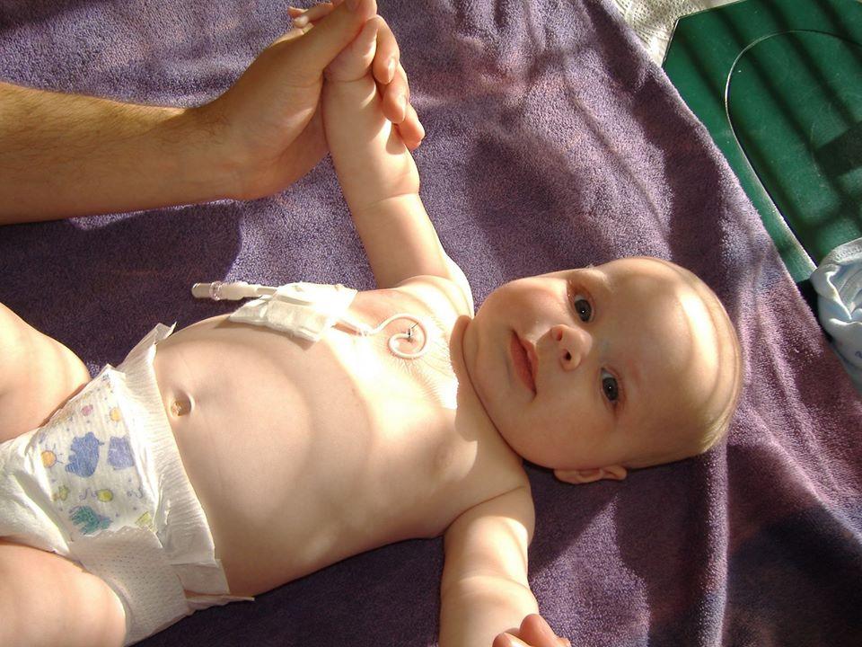 [IMAGE DESCRIPTION: A photo of an infant with a thin tube across his abdomen.]